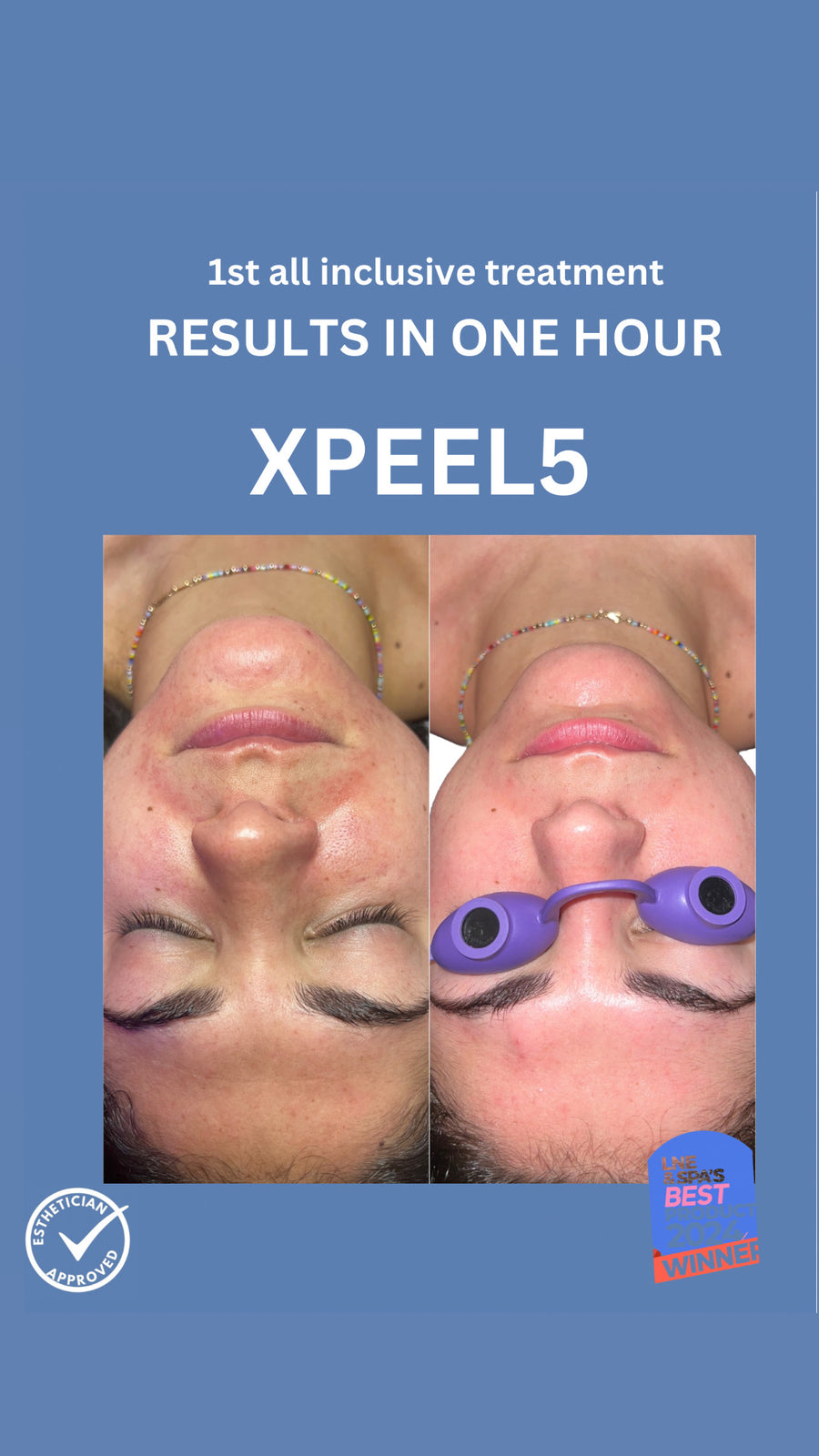 XPEEL5 (1st all inclusive treatment) book with JULIE GROSSO at XF HEADQUARTERS in CA